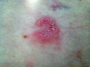 Small raised itchy bumps in a ring shape on back of upper arm.