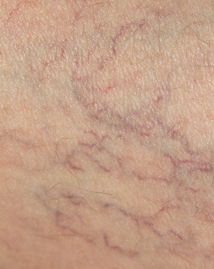 spider veins close up image