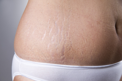 stretch marks on the skin
