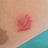 This is the circular itchy red rash by my armpit, 