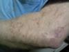 circular skin rash pattern on arm