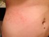 possible fungal skin rash on stomach area