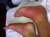 Unknown red skin rash on foot (bottom foot) and swollen red foot caused by a bug bite (top foot).