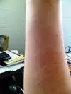 Possible prickly heat rash on arm.