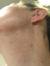 Red itchy welts on the skin of my neck.