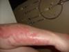 Reoccurring Itchy Skin Rash on Arm