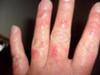 Reoccurring Itchy Skin Rash on Hand and Fingers
