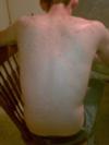 Undiagnosed Non Itchy Skin Rash on Back