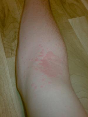 Unknown Non Itchy Skin Rash on Arm