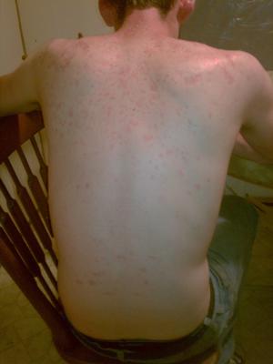 Undiagnosed Non Itchy Skin Rash on Back