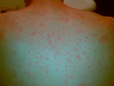 unknown skin rash on upper back