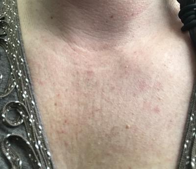 unknown rash on upper chest and neck