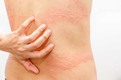 urticaria or itchy skin hives on the back or torso.