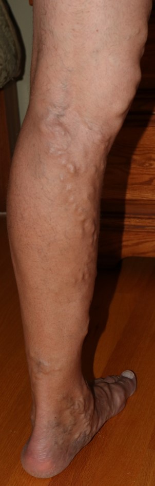 varicosevein2